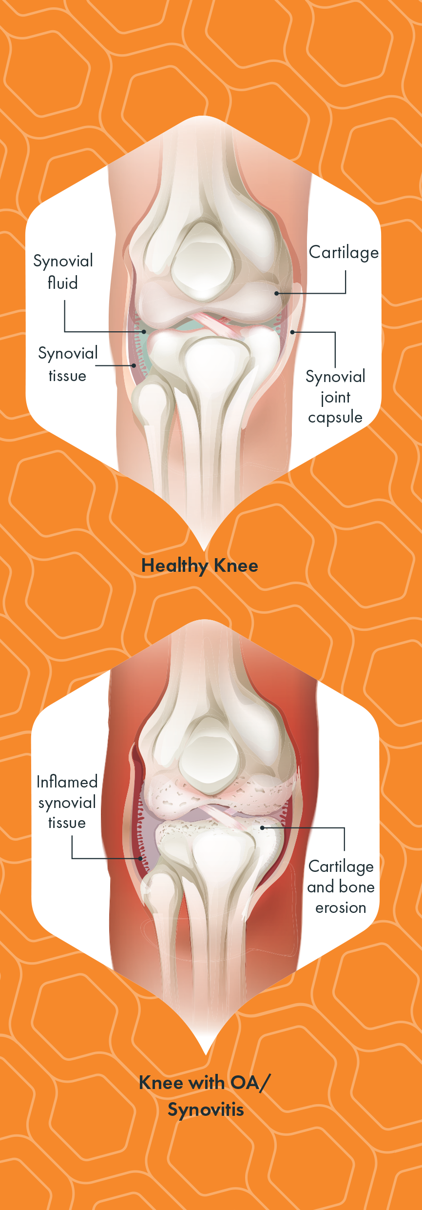 Healthy_Knee_vs._OA_Knee.png