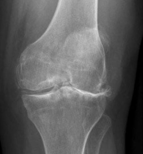 Knee_OA_XR.jpg