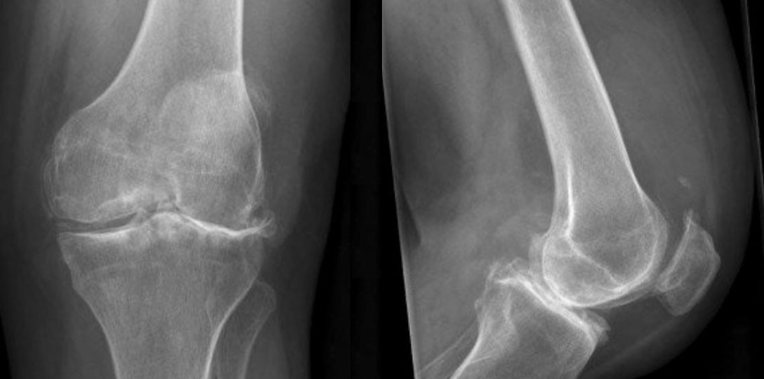 Knee_X-ray_OA_copy.jpg