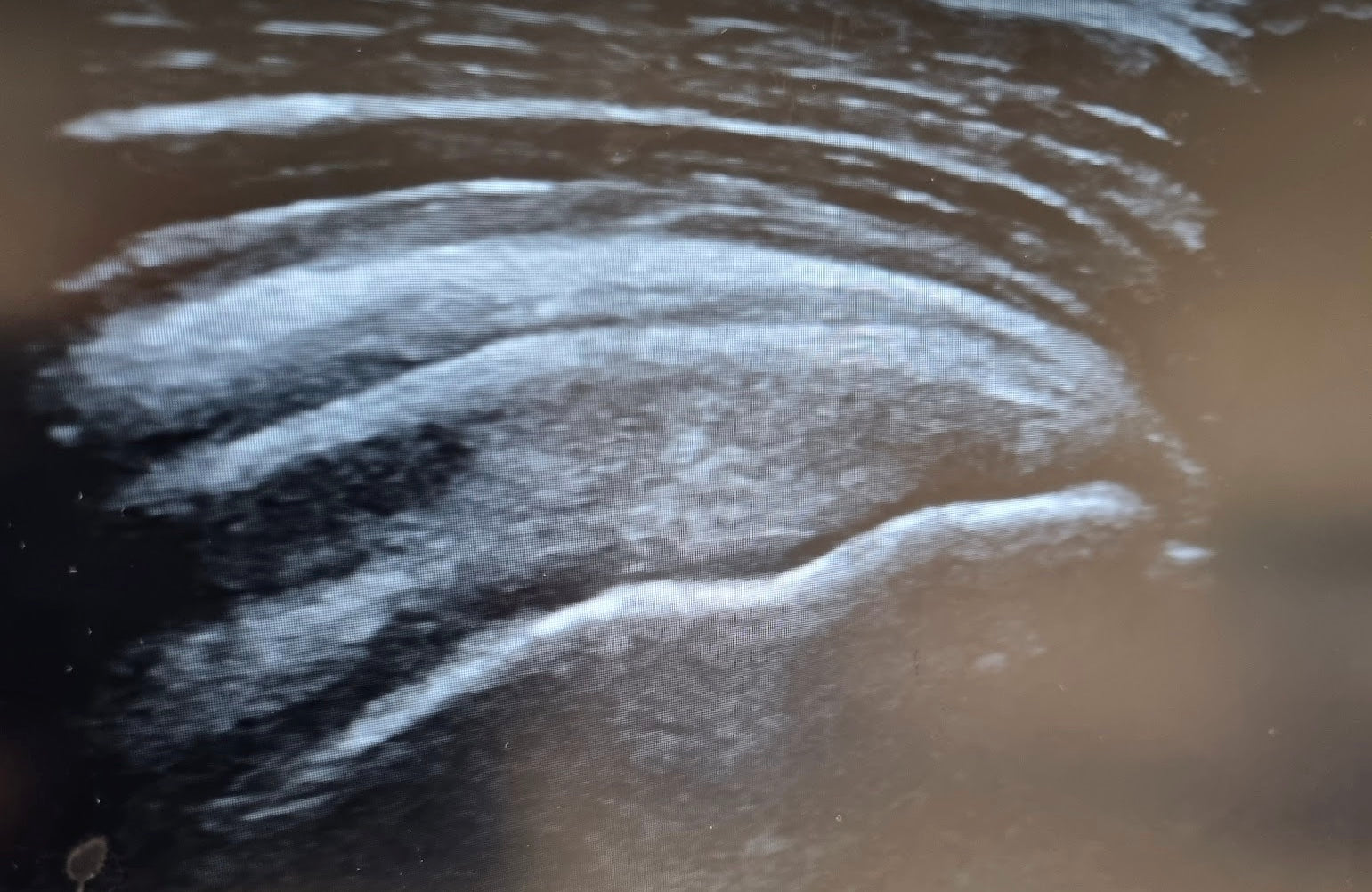 Load video: Dr Sheridan performing an ultrasound-guided subacromial bursa injection