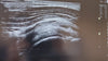 ultrasound guided shoulder injection. Ultrasound guided subacromial bursa injection